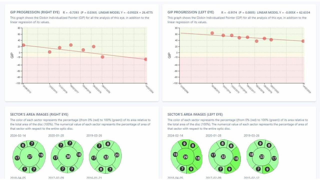 Die Advanced Glaucoma Progression AI funktioniert, indem sie den Fortschritt von Glaukomen über die Zeit überwacht und selbst geringfügige Veränderungen erkennt. ​ Sie nutzt den sogenannten „Glaucoma Index of Progression (GIP)“ zur präzisen Verfolgung der möglichen Erkrankung. ​Eine besondere Stärke der Technologie liegt in der gleichzeitigen Analyse beider Augen, was Augenoptikern und Optometristen ermöglicht, die Ergebnisse nebeneinander zu betrachten und ein umfassendes Bild der Sehnervgesundheit und der umliegenden Strukturen zu erhalten.