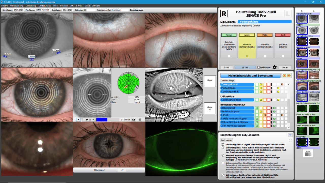 JENVIS Pro Dry Eye Software - das Werkzeug zur Analyse des Trockenen Auges