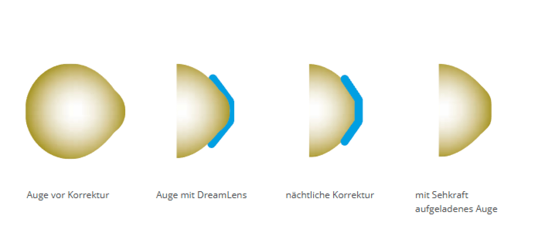 Vier Diagramme zeigen Veränderungen der Augenform: normales Auge, Auge mit DreamLens, Nachtlinsenkorrektur und Auge mit verbesserter Sehkraft nach Linseneinsatz. Blaue Linien veranschaulichen die Linsenanwendung im zweiten und dritten Bild. Deutsche Beschriftungen darunter.