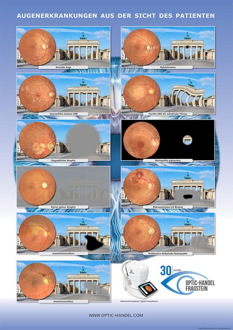 Ein deutsches medizinisches Poster, das zeigt, wie sich verschiedene Augenkrankheiten auf das Sehvermögen auswirken, illustriert mit Netzhautbildern und Fotos des Brandenburger Tors bei verschiedenen Sehbehinderungen.