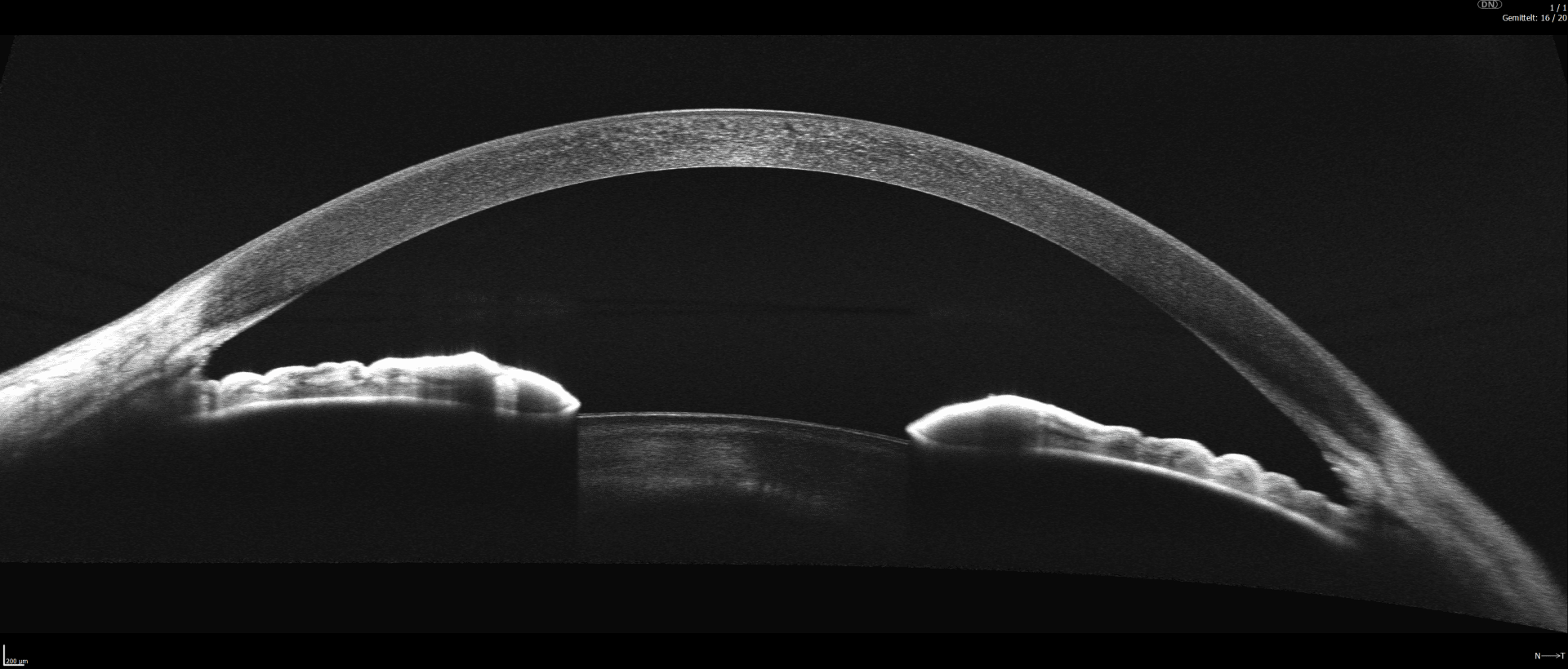 OCT-Querschnittsbild eines menschlichen Auges, das die gekrümmte Hornhaut im oberen Bereich und unregelmäßige, erhabene Strukturen am unteren Rand zeigt, bei denen es sich wahrscheinlich um die Iris und den vorderen Kammerwinkel handelt.