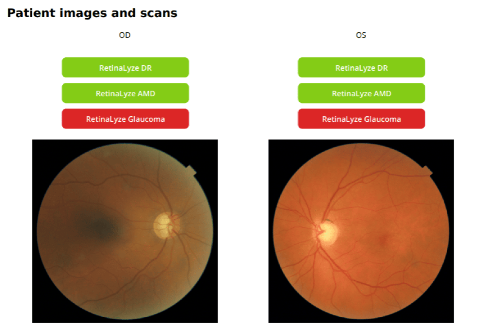 Gezeigt werden zwei Netzhautfundusbilder, die mit OD und OS gekennzeichnet sind. Grüne Schaltflächen zeigen negative Ergebnisse für DR und AMD, während rote Schaltflächen positive Ergebnisse für Glaukom in beiden Augen anzeigen.