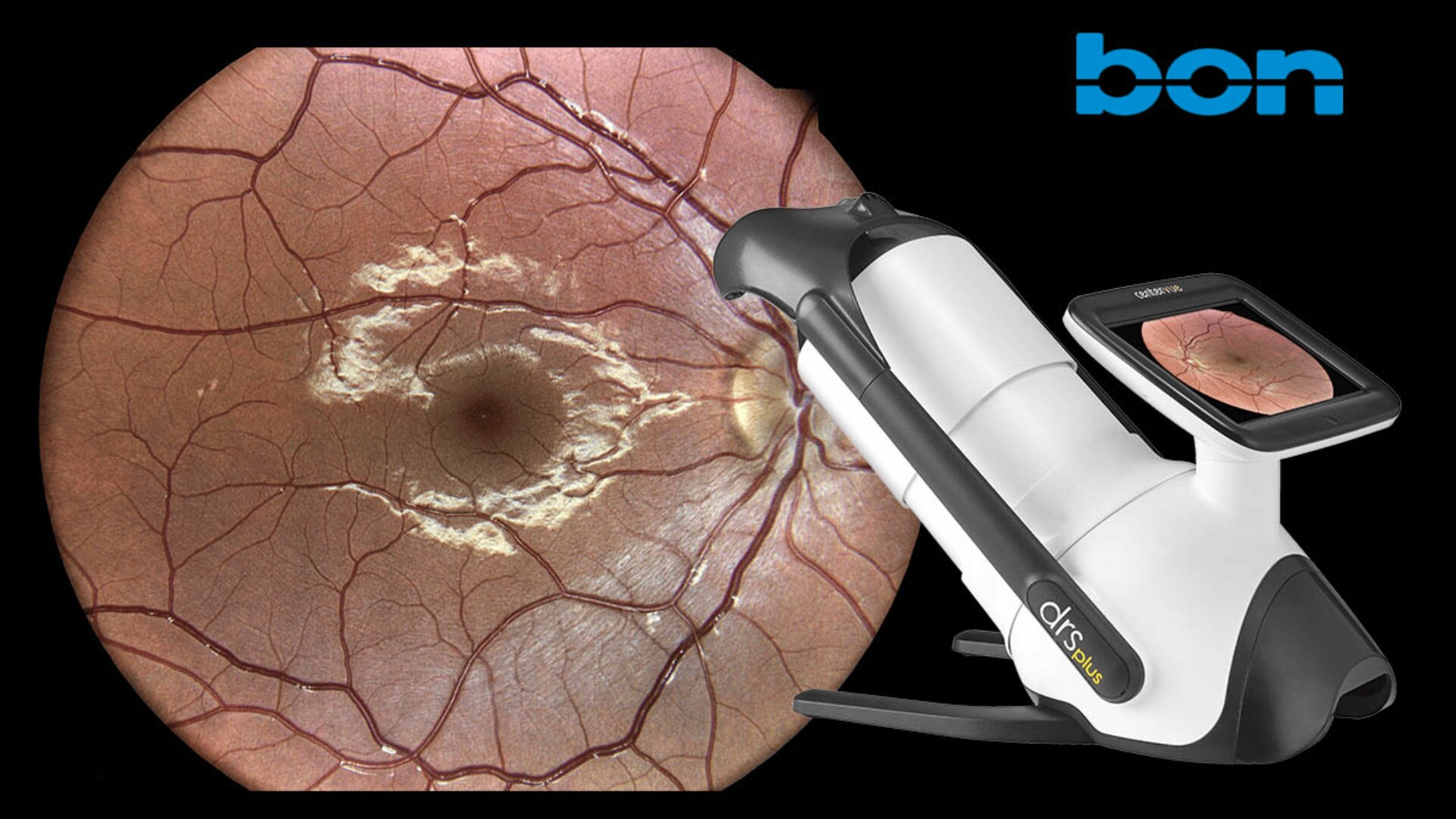 Ein Netzhautbildgebungsgerät zeigt eine Nahaufnahme der Netzhaut, auf der Blutgefäße und Sehnervenpapille hervorgehoben sind. Das Bon-Logo erscheint in der oberen rechten Ecke auf schwarzem Hintergrund.