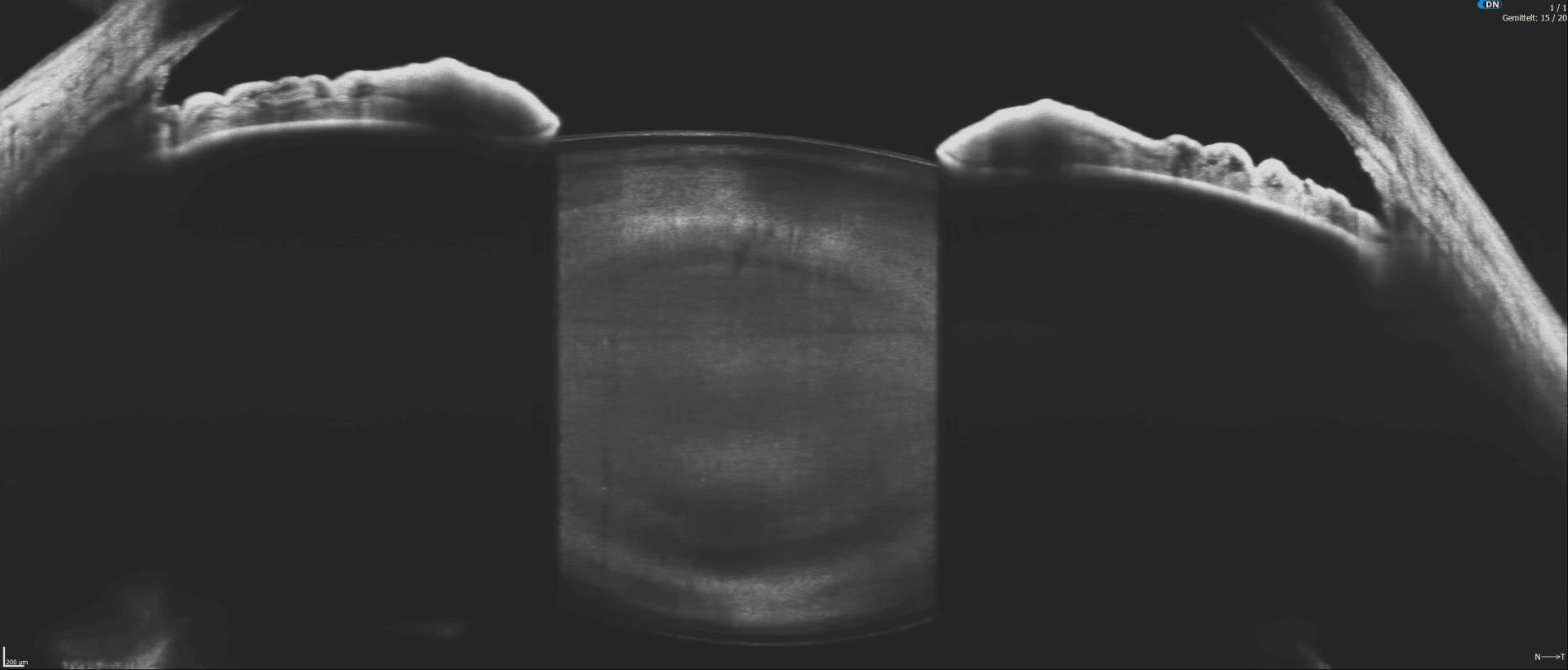 Schwarz-Weiß-Röntgenbild, das einen Nahquerschnitt eines mechanischen oder metallischen Objekts mit gekrümmten und geriffelten Kanten auf beiden Seiten und einem kreisförmigen, transparenten Bereich in der Mitte zeigt.