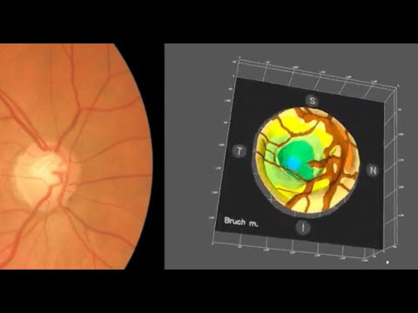 Ein medizinisches Bild, das links einen Sehnervenkopf und rechts eine topografische 3D-Karte des Sehnervenkopfes zeigt, die zur Beurteilung der Augengesundheit verwendet wird.