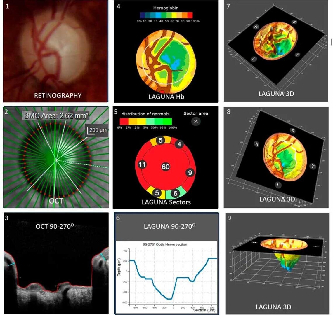 Anwender können fortan von einem einfachen 2D-Foto ausgehend die Form und Tiefe des Sehnervs und seine Veränderungen im Laufe der Zeit visualisieren.