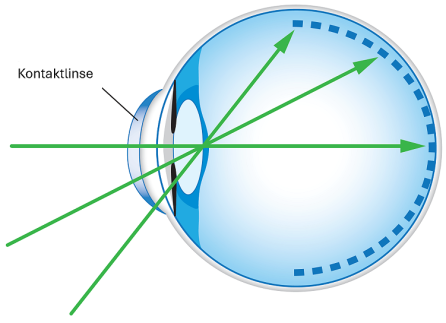 Schema eines Auges mit einer beschrifteten Kontaktlinse auf der Hornhaut. Die drei grünen Pfeile stellen Lichtstrahlen dar, die in das Auge eintreten und sich auf der Netzhaut bündeln.
