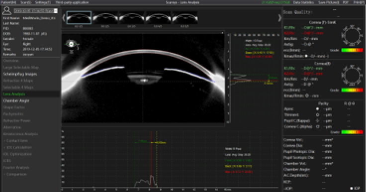 Ein Screenshot einer Software für die ophthalmologische Bildgebung zeigt einen Querschnittsscan eines menschlichen Auges mit Krümmungs- und Dickenmessungen, mit verschiedenen Analysegrafiken und Daten auf der rechten und linken Seite.