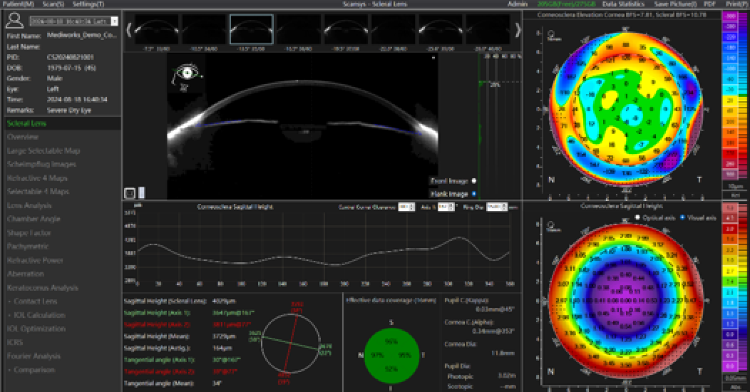 Eine medizinische Bildgebungssoftware zeigt Hornhauttopographiedaten an, einschließlich eines Seitenquerschnitts eines Auges, 2D-Farbkarten der Hornhautform, numerische Messungen und Diagramme zur Analyse der Hornhautoberfläche und -dicke.